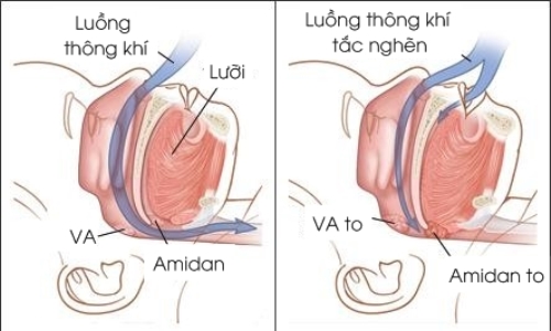 Bị Ngáy Khi Ngủ Là Bệnh Gì? Khám Phá Nguyên Nhân và Giải Pháp