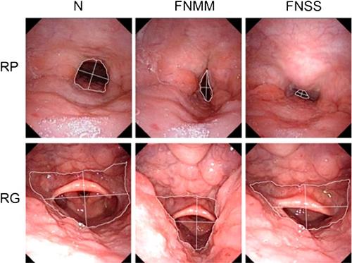 4. Phương Pháp Chẩn Đoán và Điều Trị