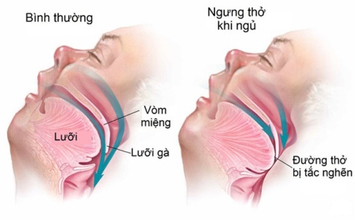 Quên Thở Khi Ngủ: Nguyên Nhân, Triệu Chứng Và Cách Điều Trị Hiệu Quả